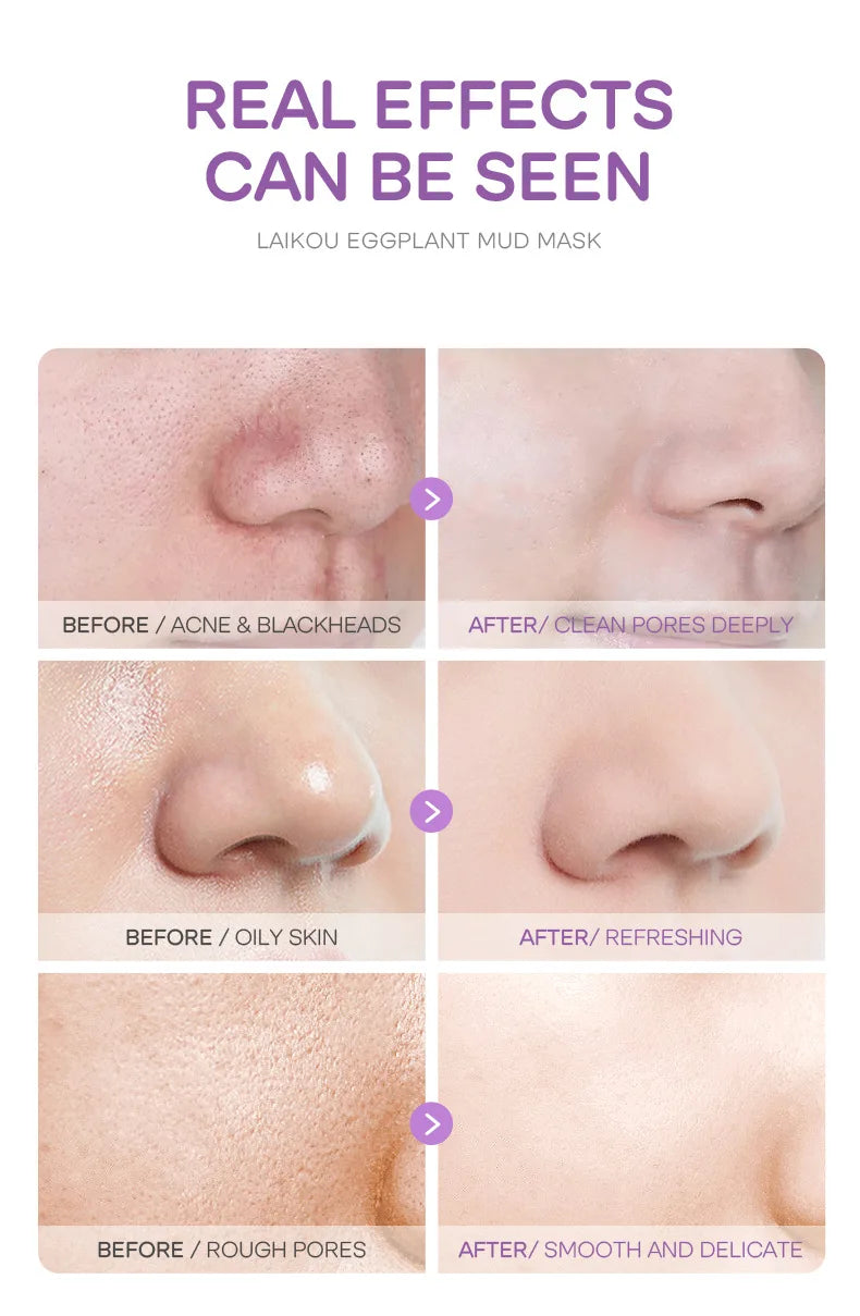 Eggplant Mud Mask Set (5pcs)