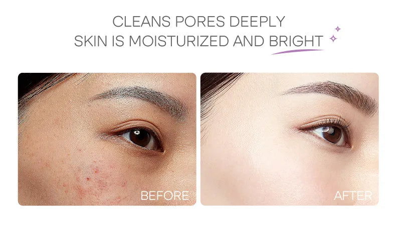 Eggplant Mud Mask Set (5pcs)