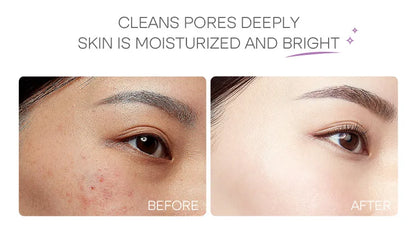 Eggplant Mud Mask Set (5pcs)